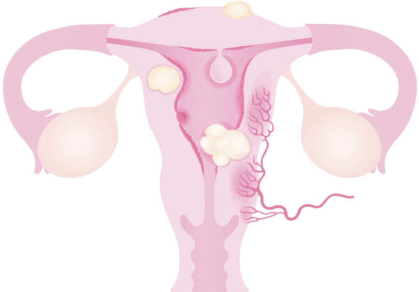 Base uterus