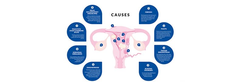 Infographic: Causes of heavy periods