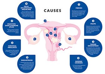 Infographic: Causes of heavy periods