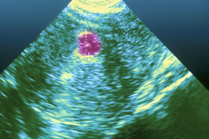 Uterine fibroids and their consequences.